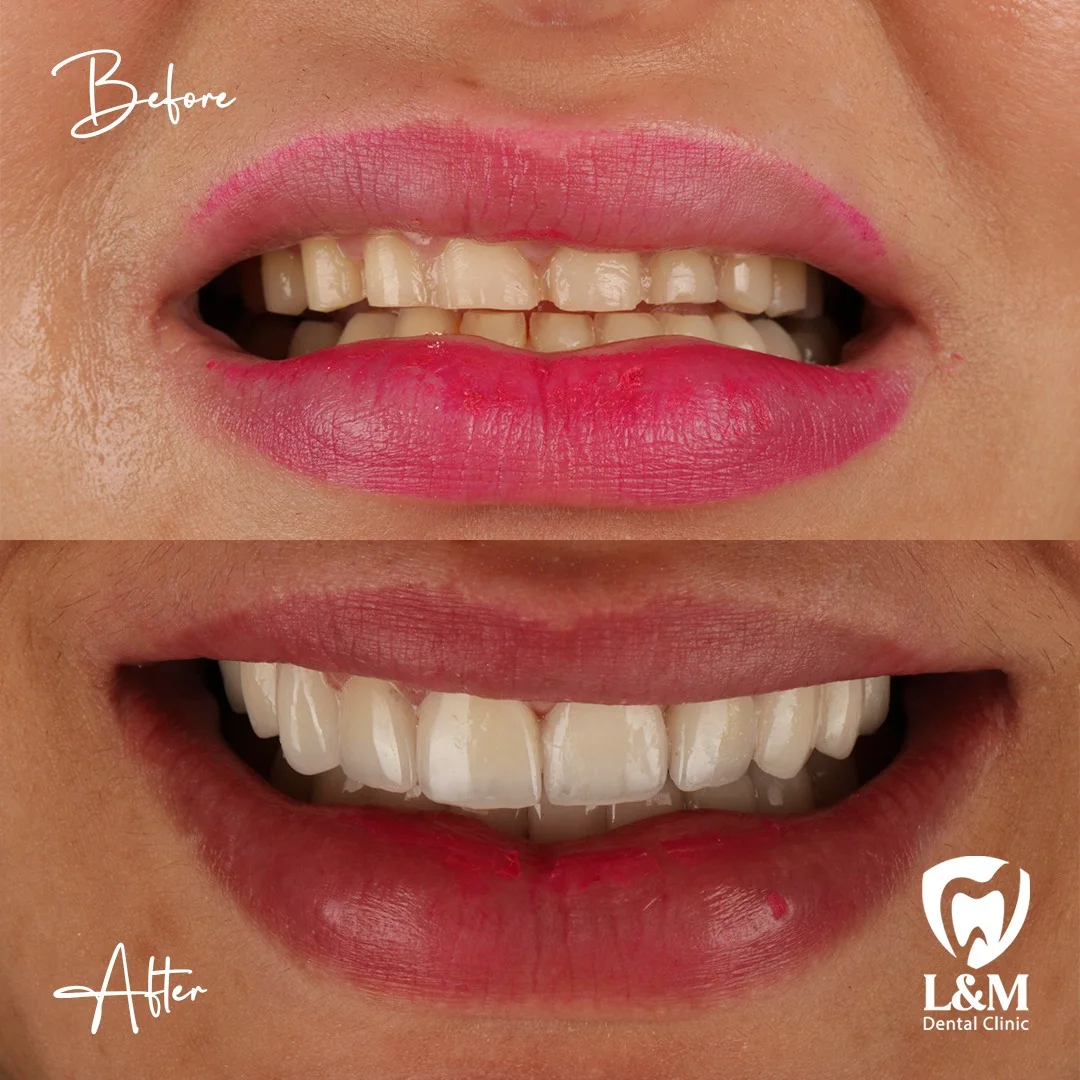 Before and after comparison