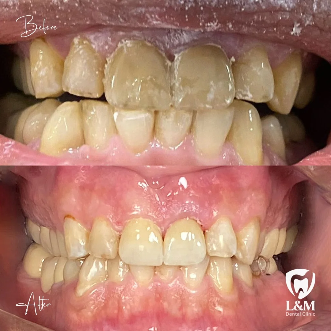 Before and after comparison