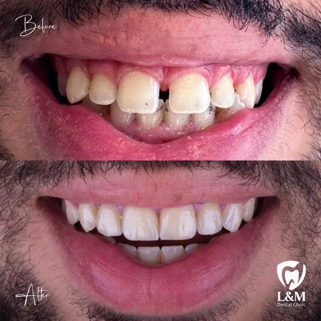 Before and after comparison