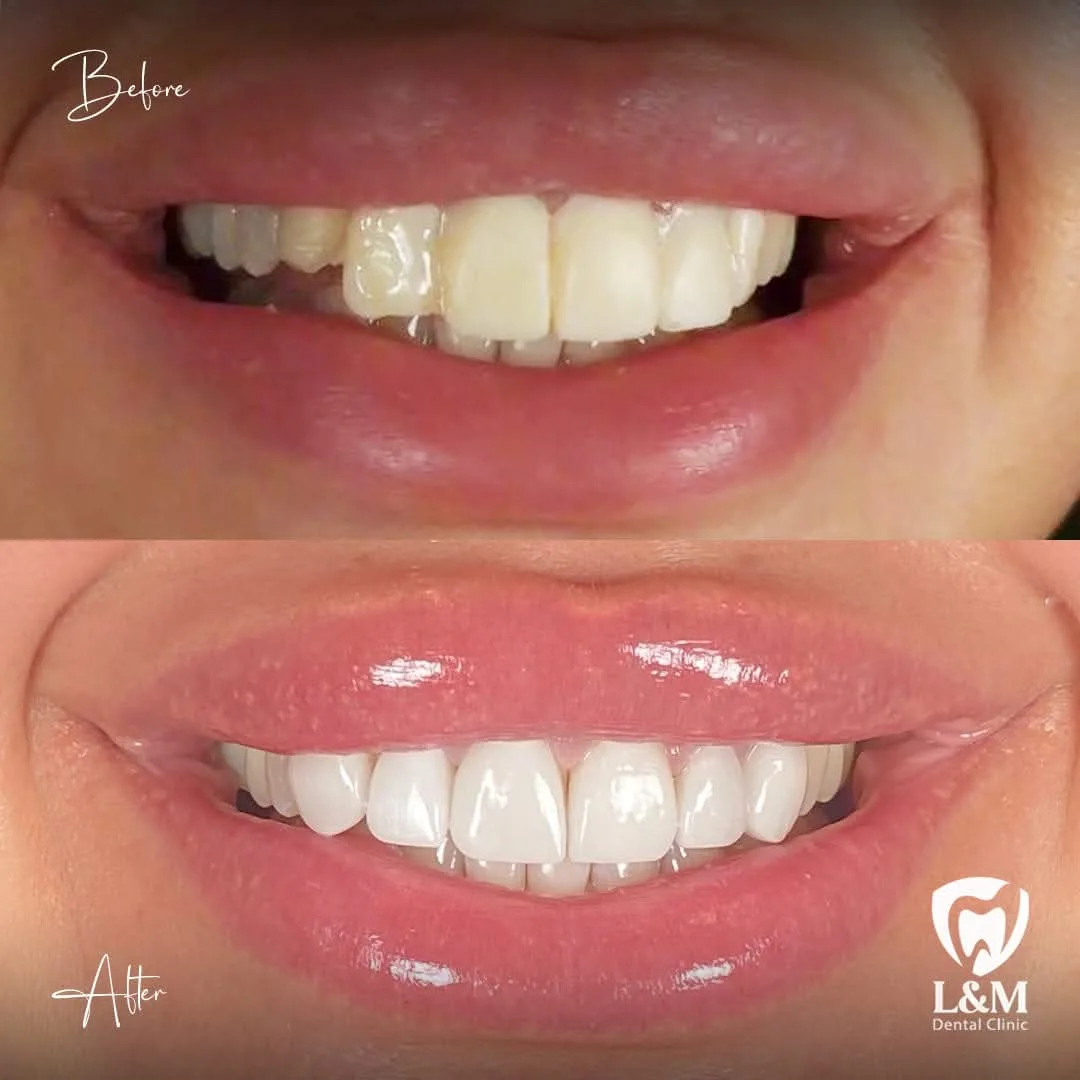 Before and after comparison