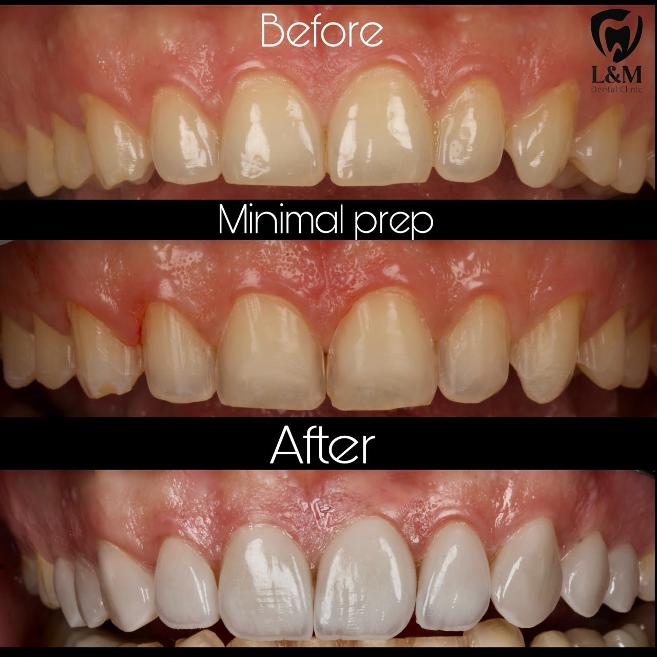 Before and after comparison